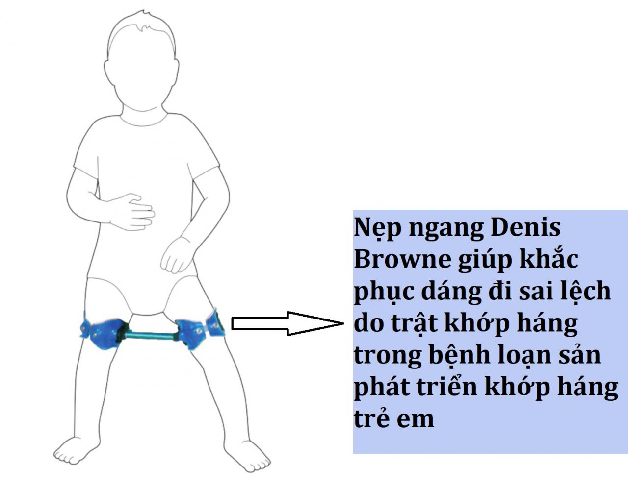 nẹp chống trật khớp háng