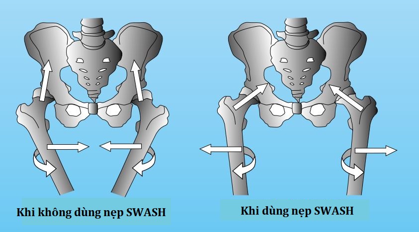 nẹp hông loạn sản xương hông